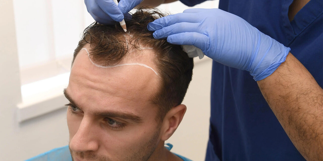 Važna pravila nakon transplantacije kose