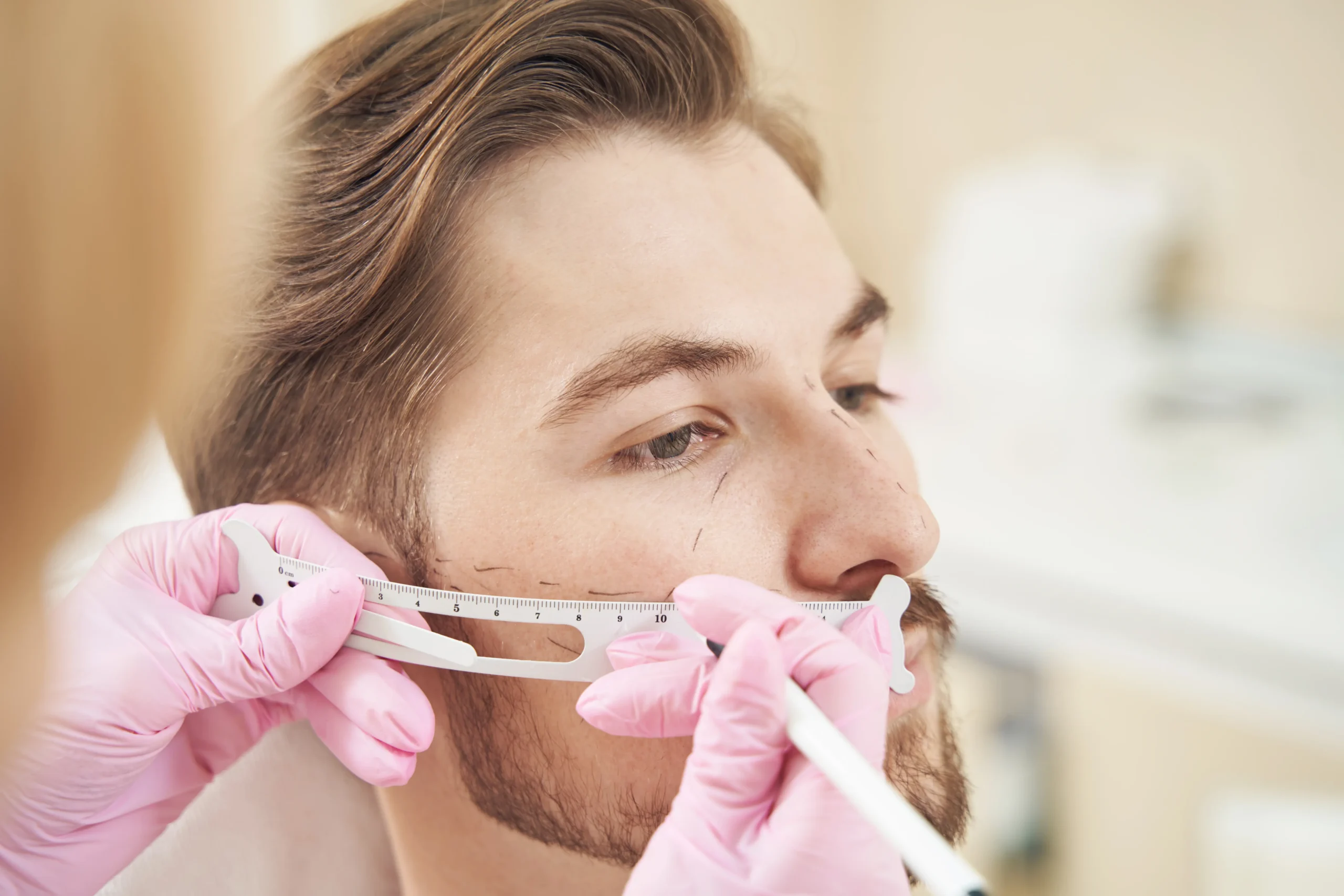 Koliko traje oporavak nakon transplantacije brade?
