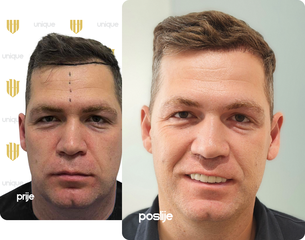 https://uniquehairtransplant.ba/wp-content/uploads/2025/08/slider-before-after-leon-obad.png