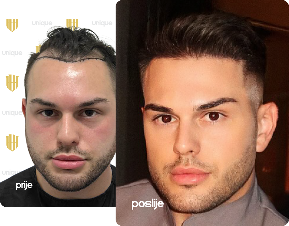 https://uniquehairtransplant.ba/wp-content/uploads/2025/08/slider-before-after-marko-janjic.png