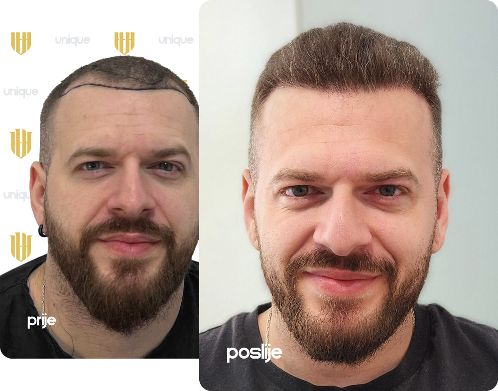 https://uniquehairtransplant.ba/wp-content/uploads/2025/08/slider-before-after-namik-djulic.png