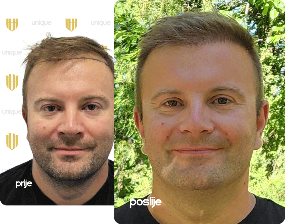 https://uniquehairtransplant.ba/wp-content/uploads/2025/08/slider-before-after-ratko-martinovic-dene.png